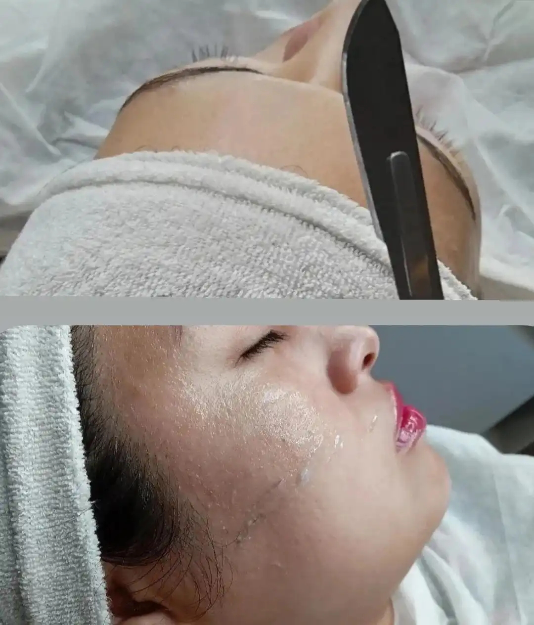 Dermaplaning en Trelew