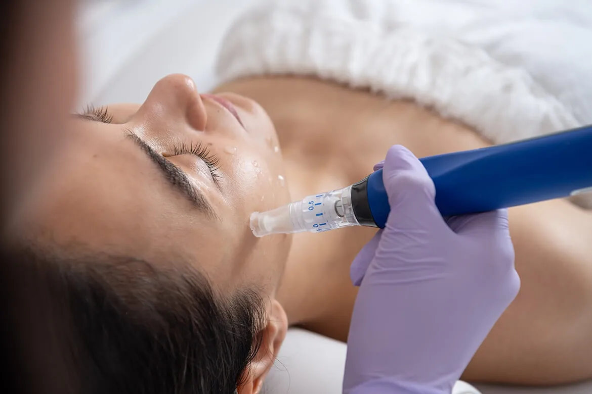 Microneedling en Trelew